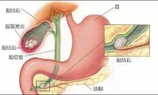 為什么要切除膽囊？